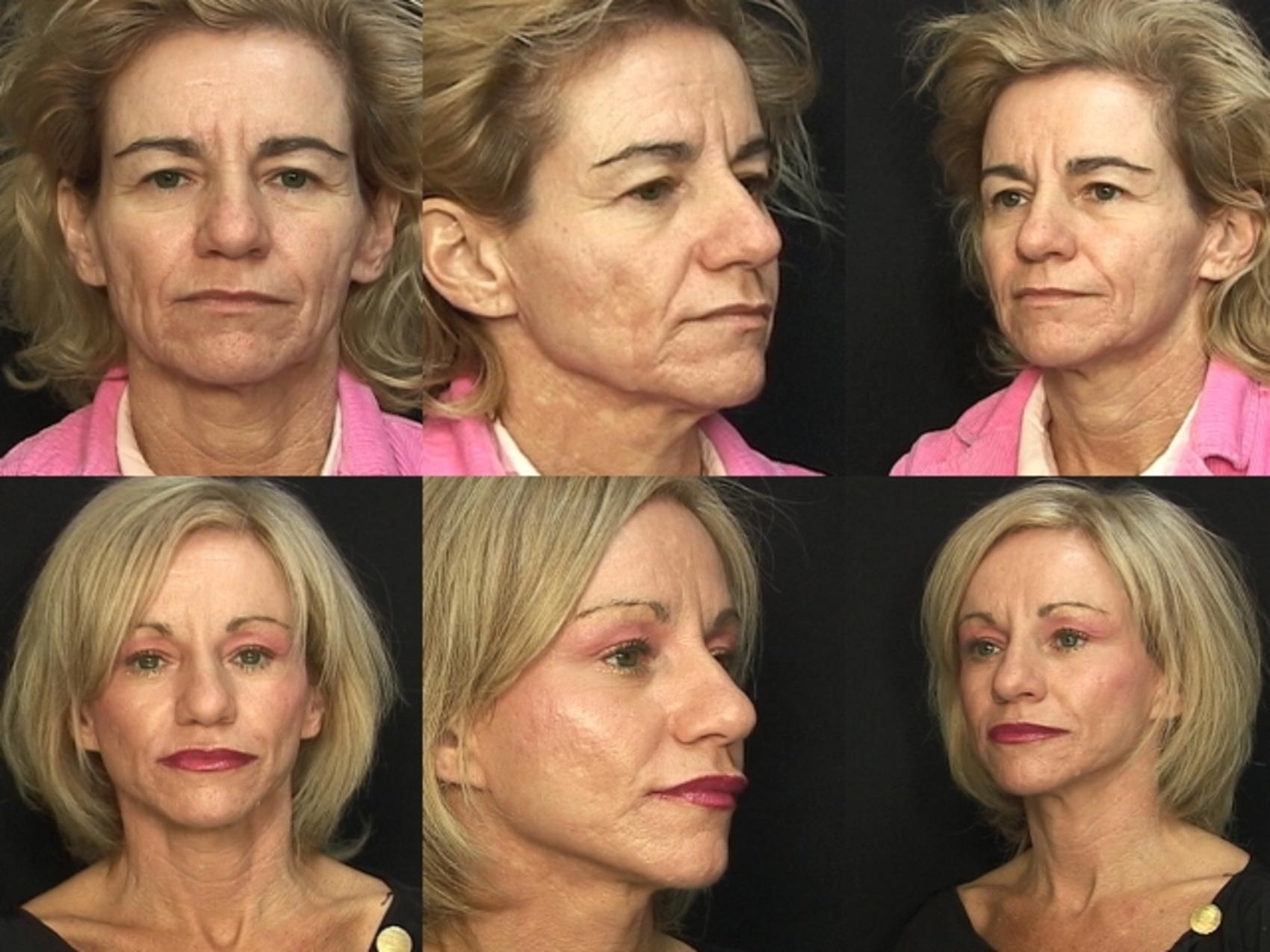 Before & After Browlift Case 62 View #1 View in Panama City & Pensacola, Florida