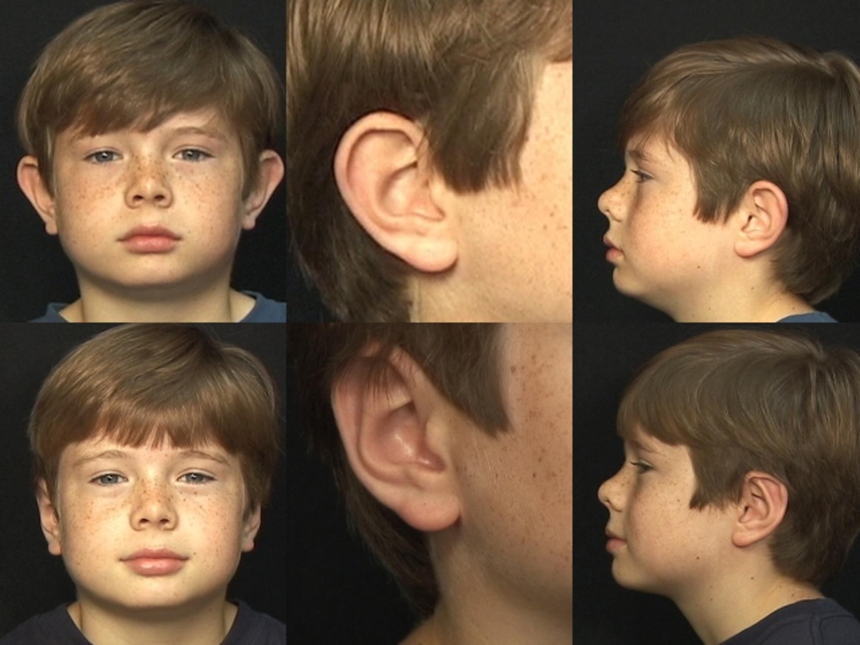 Before & After Ear Surgery (Otoplasty) Case 14 View #1 View in Panama City & Pensacola, Florida