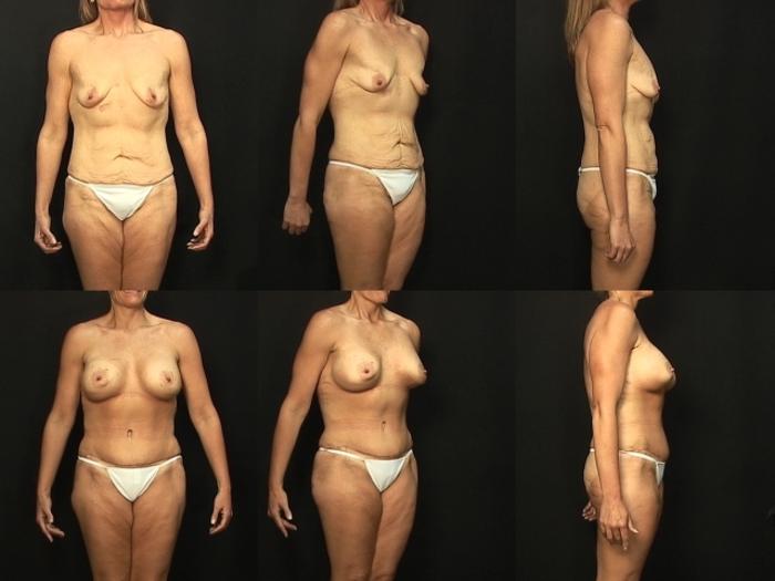 Before & After Abdominoplasty Case 134 View #1 View in Panama City & Pensacola, Florida