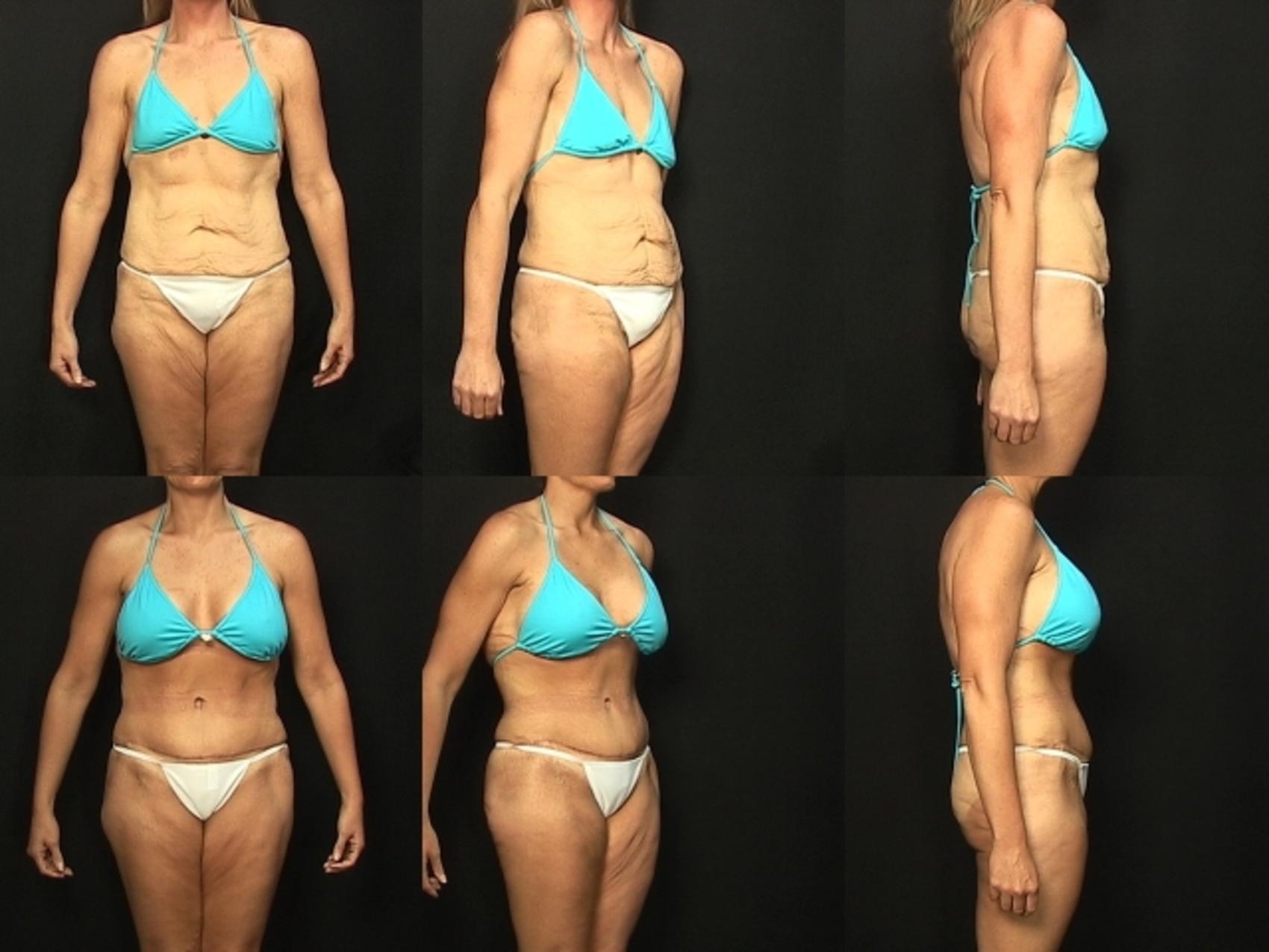 Before & After Abdominoplasty Case 134 View #2 View in Destin & Pensacola, Florida