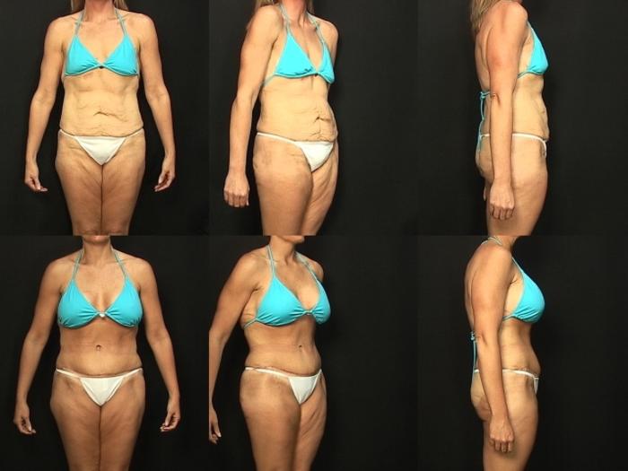 Before & After Abdominoplasty Case 134 View #2 View in Panama City & Pensacola, Florida