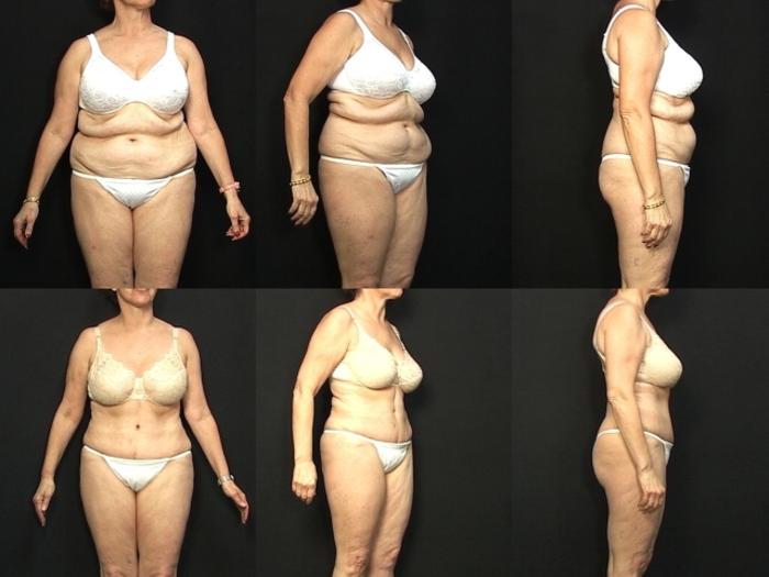 Before & After Abdominoplasty Case 22 View #1 View in Panama City & Pensacola, Florida