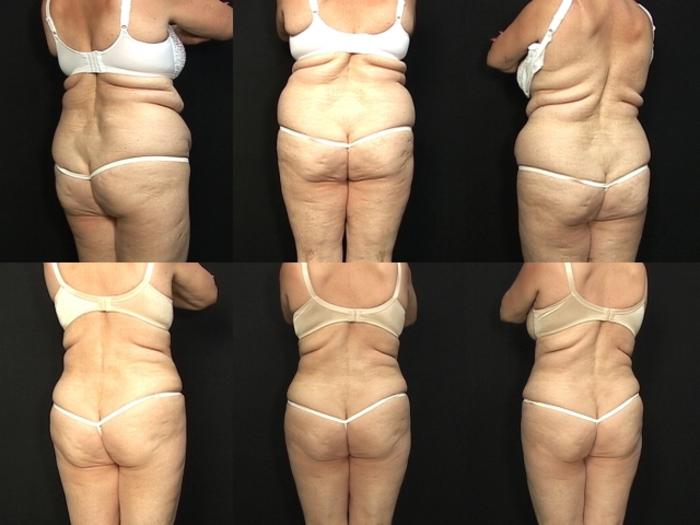 Before & After Abdominoplasty Case 22 View #2 View in Panama City & Pensacola, Florida