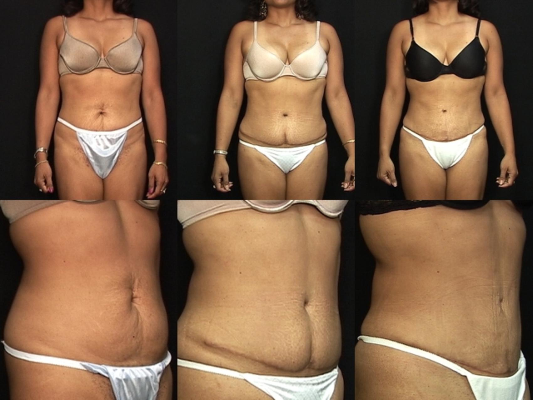 Before & After Abdominoplasty Case 24 View #1 View in Panama City & Pensacola, Florida