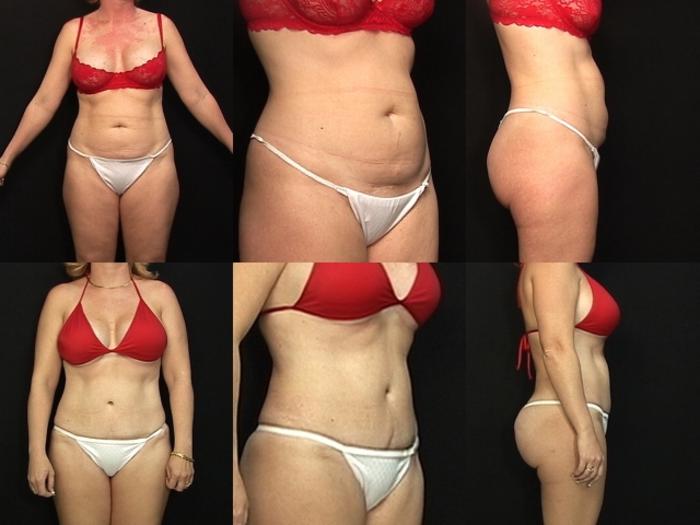 Before & After Abdominoplasty Case 25 View #1 View in Panama City & Pensacola, Florida