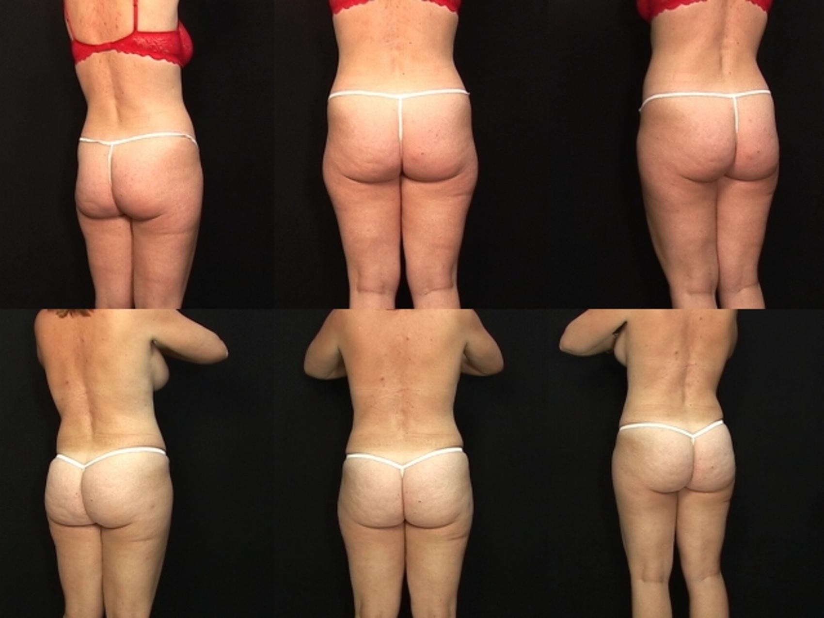 Before & After Abdominoplasty Case 25 View #2 View in Destin & Pensacola, Florida