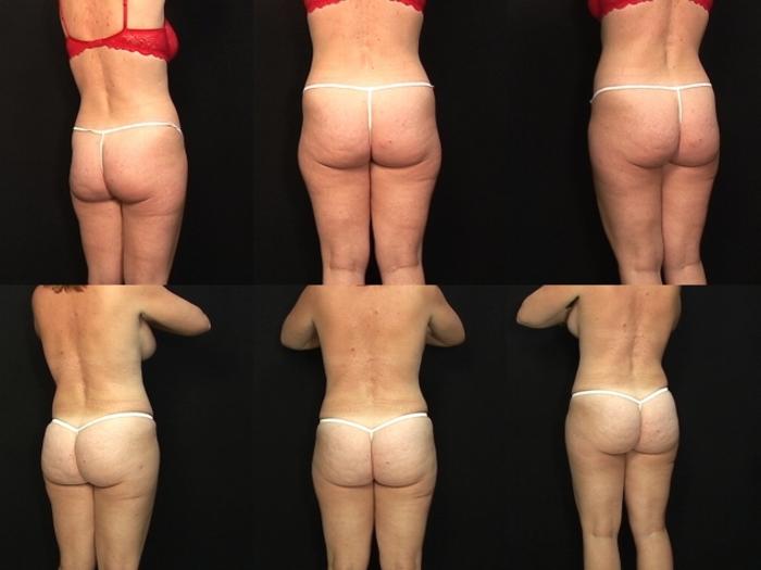 Before & After Abdominoplasty Case 25 View #2 View in Panama City & Pensacola, Florida