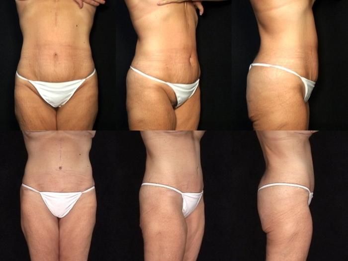 Before & After Abdominoplasty Case 26 View #1 View in Panama City & Pensacola, Florida