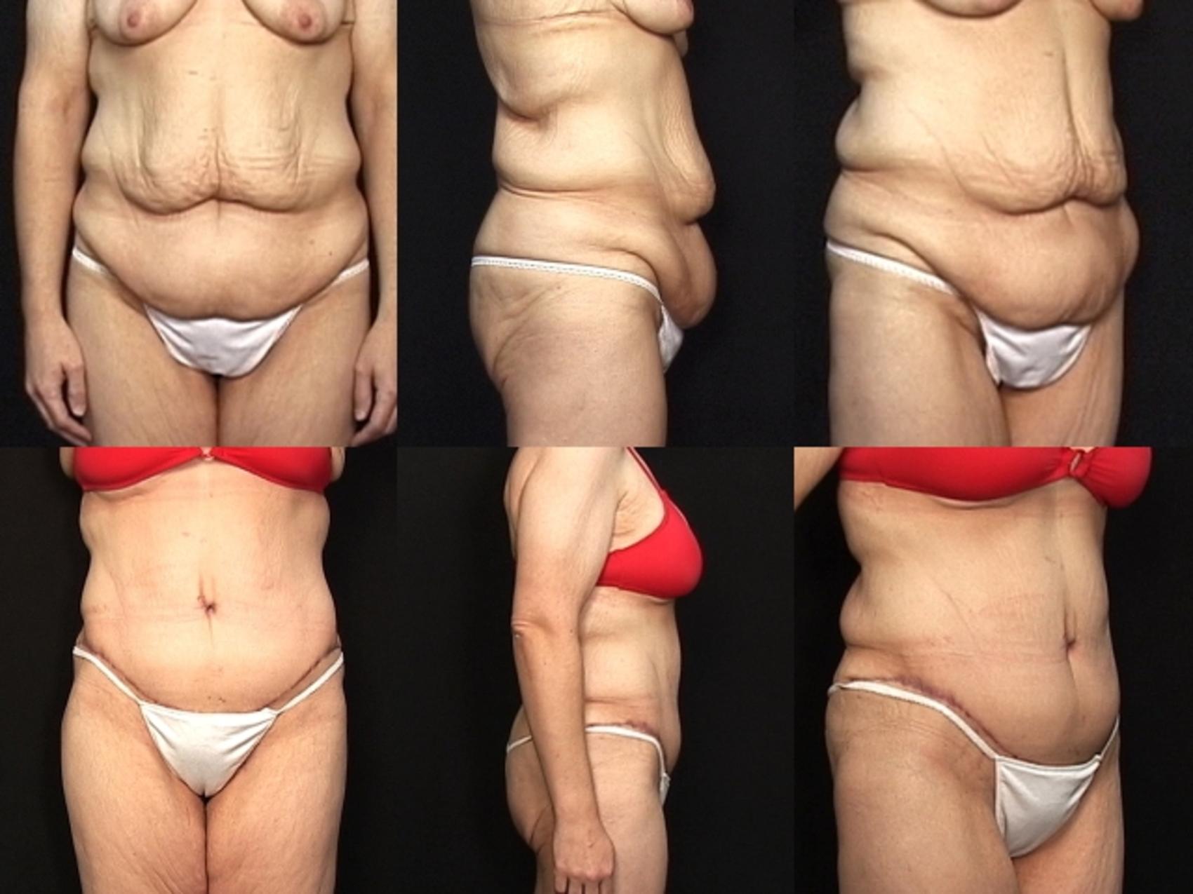 Before & After Abdominoplasty Case 28 View #1 View in Panama City & Pensacola, Florida