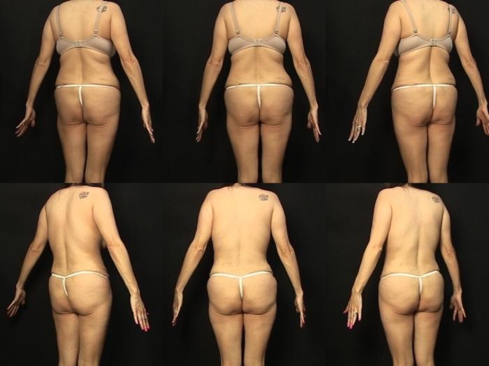 Before & After Abdominoplasty Case 296 View #2 View in Panama City & Pensacola, Florida