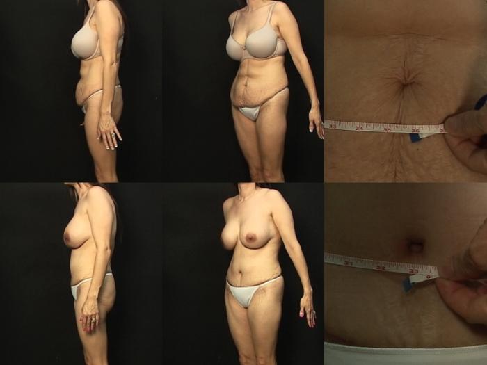 Before & After Abdominoplasty Case 296 View #3 View in Panama City & Pensacola, Florida
