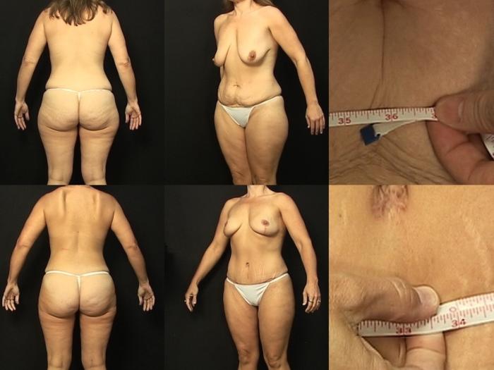 Before & After Abdominoplasty Case 298 View #2 View in Panama City & Pensacola, Florida