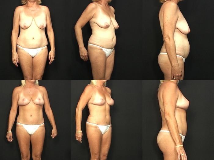 Before & After Abdominoplasty Case 31 View #1 View in Panama City & Pensacola, Florida