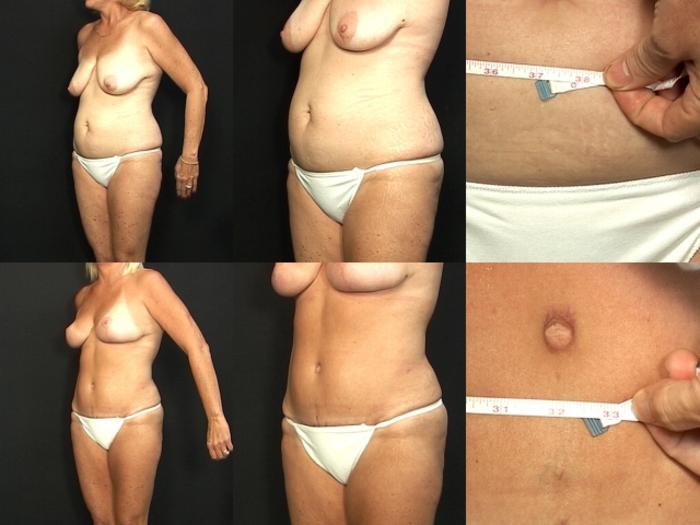 Before & After Abdominoplasty Case 31 View #2 View in Panama City & Pensacola, Florida