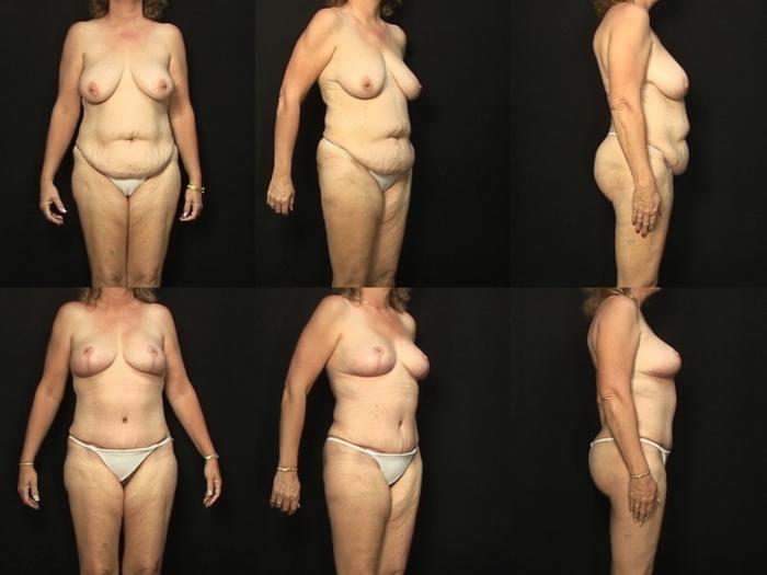 Before & After Abdominoplasty Case 34 View #1 View in Panama City & Pensacola, Florida