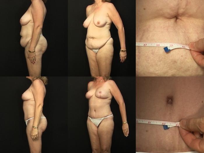 Before & After Abdominoplasty Case 34 View #2 View in Panama City & Pensacola, Florida