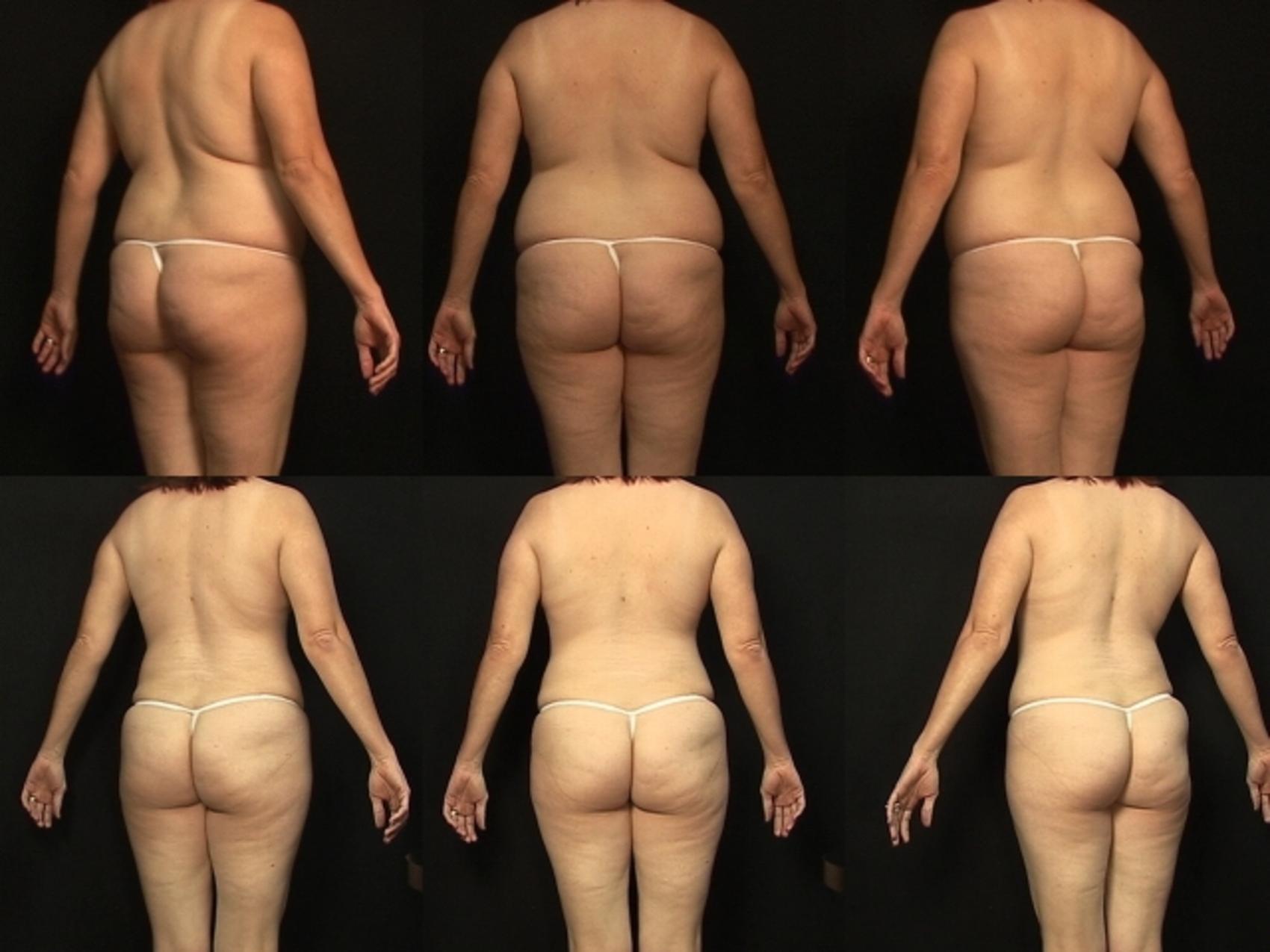 Before & After Abdominoplasty Case 378 View #2 View in Destin & Pensacola, Florida