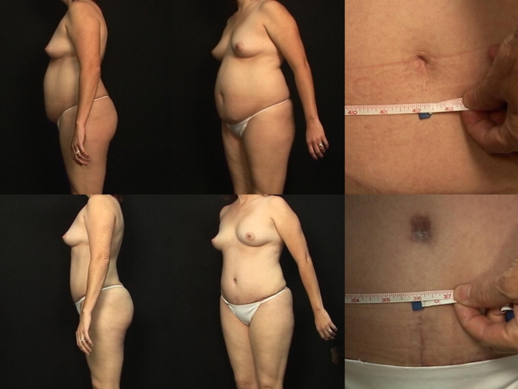 Before & After Abdominoplasty Case 378 View #3 View in Destin & Pensacola, Florida