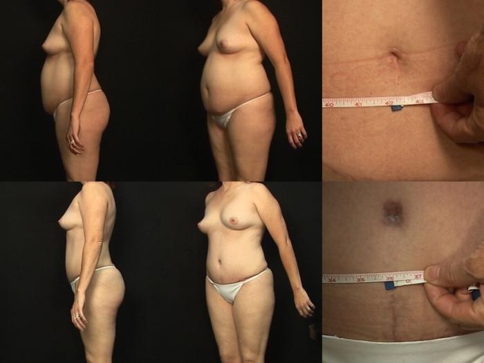 Before & After Abdominoplasty Case 378 View #3 View in Panama City & Pensacola, Florida
