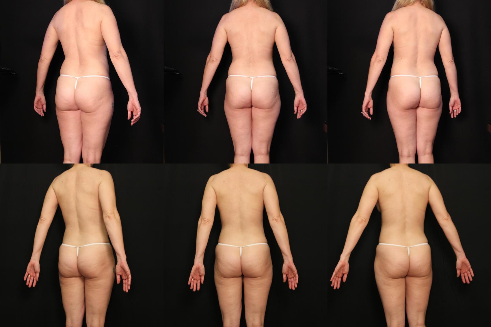 Before & After Abdominoplasty Case 455 View #2 View in Destin & Pensacola, Florida