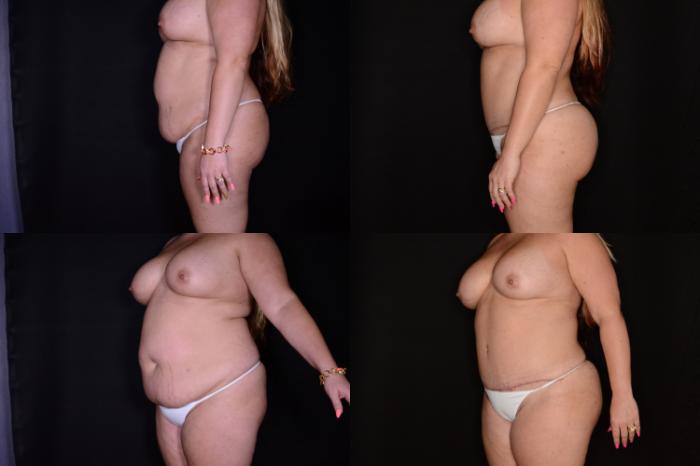Before & After Abdominoplasty Case 523 View #1 View in Panama City & Pensacola, Florida