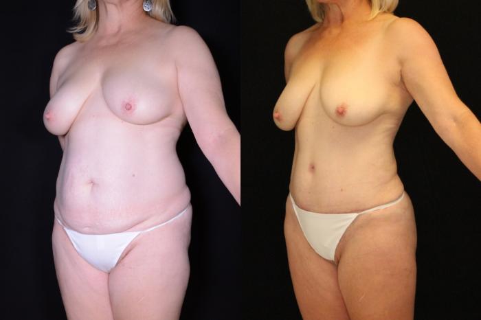 Before & After Abdominoplasty Case 547 View #1 View in Panama City & Pensacola, Florida