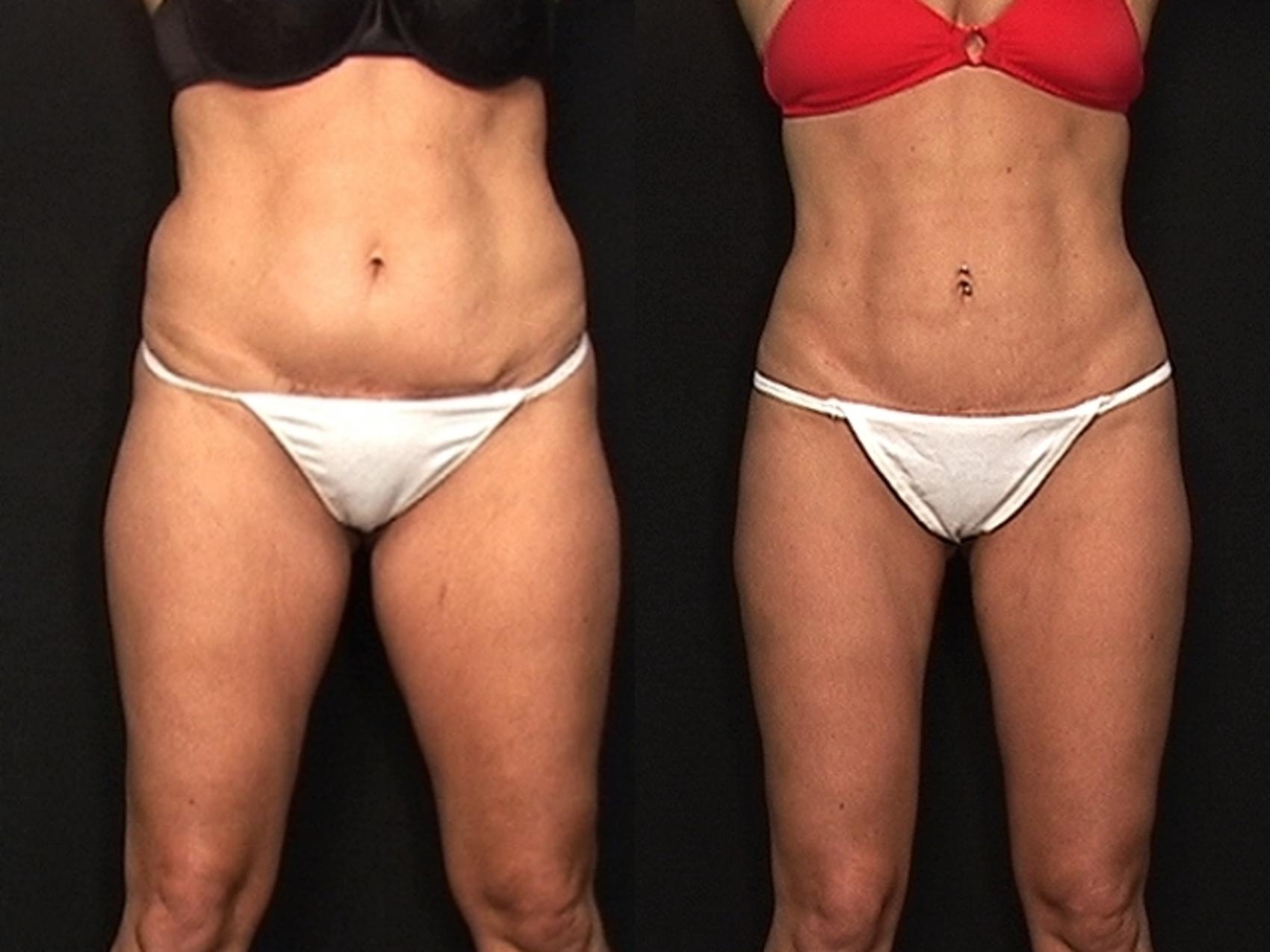 Before & After Abdominoplasty Case 549 View #1 View in Panama City & Pensacola, Florida