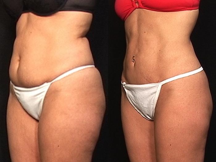 Before & After Abdominoplasty Case 550 View #1 View in Panama City & Pensacola, Florida