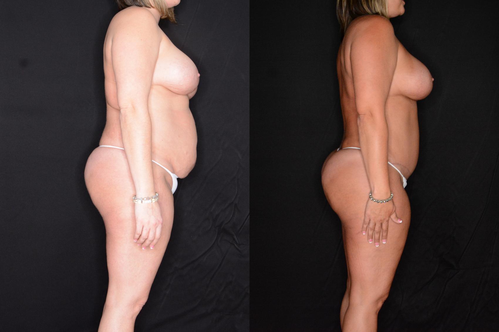 Before & After Abdominoplasty Case 567 View #1 View in Panama City & Pensacola, Florida
