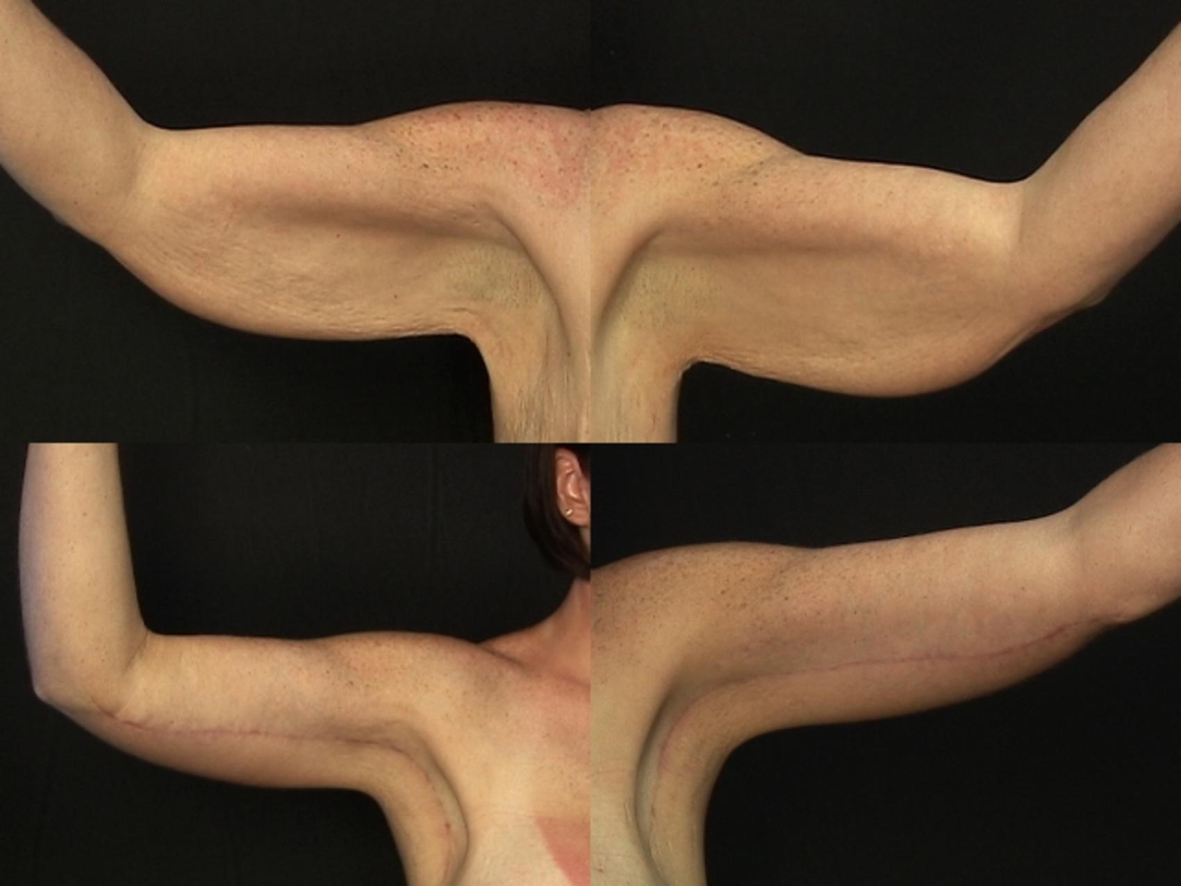 Before & After Brachioplasty Case 288 View #2 View in Destin & Pensacola, Florida