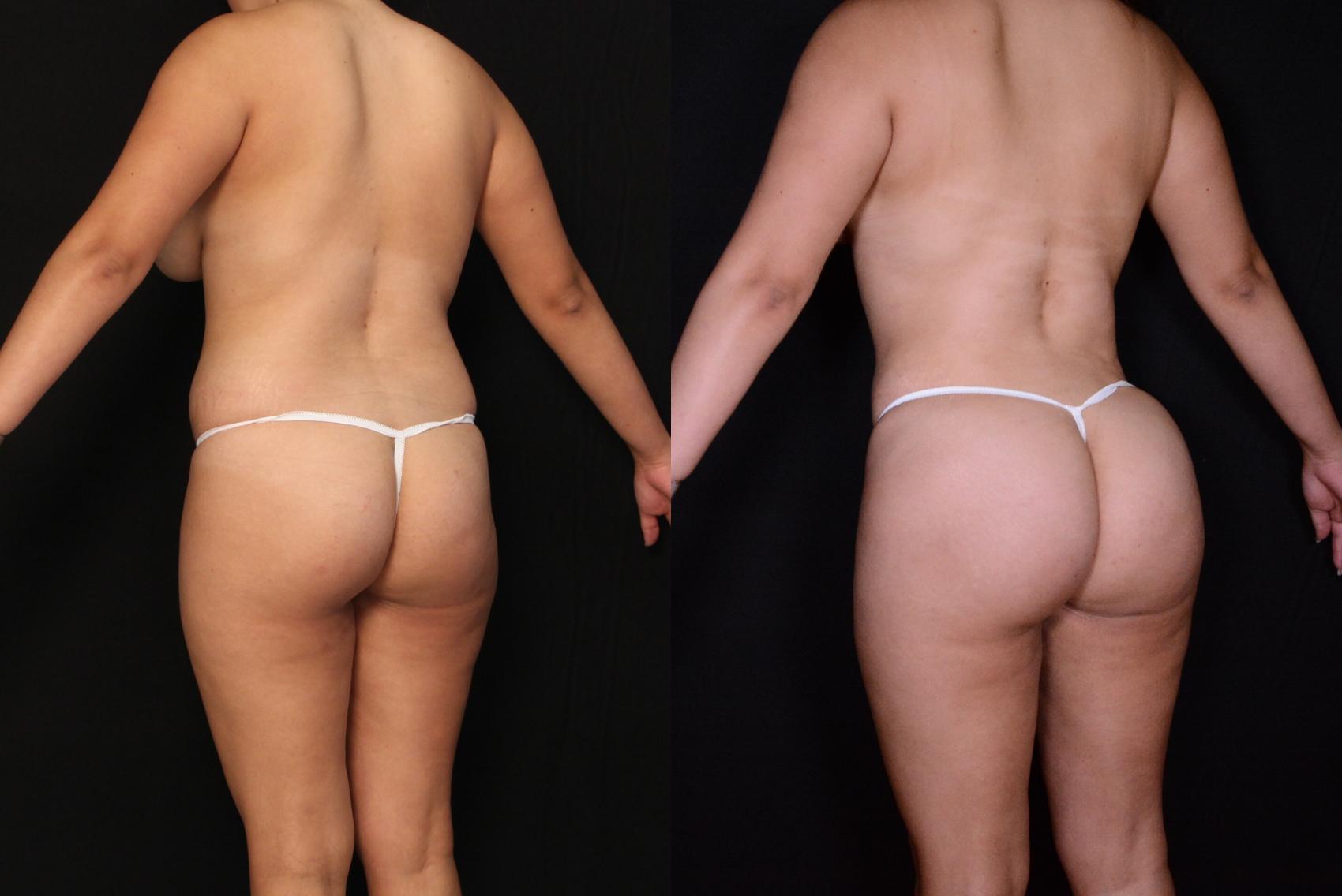 Before & After Brazilian Butt Lift Case 513 View #1 View in Panama City & Pensacola, Florida
