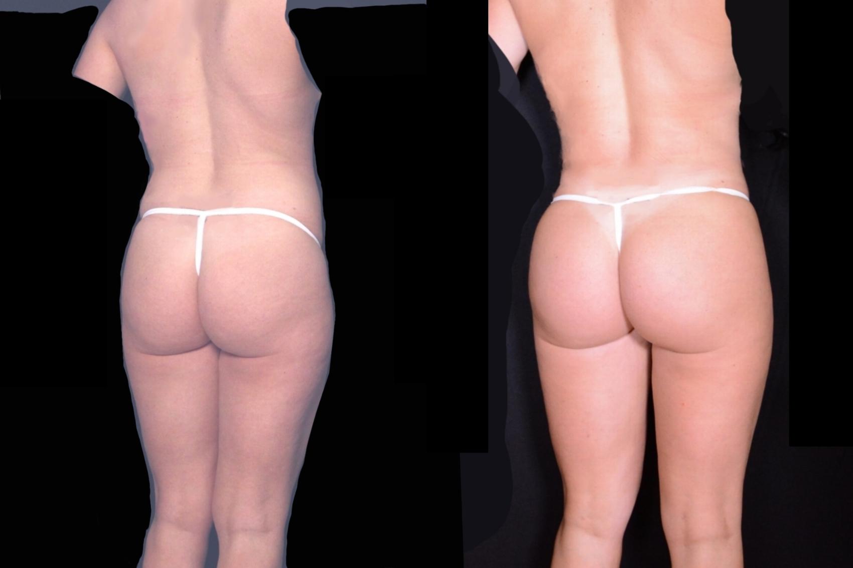 Before & After Brazilian Butt Lift Case 535 View #1 View in Panama City & Pensacola, Florida