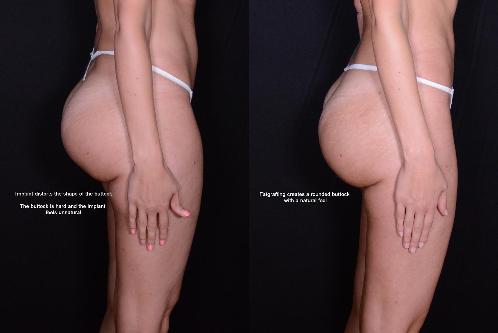 Before & After Brazilian Butt Lift Case 536 View #1 View in Panama City & Pensacola, Florida