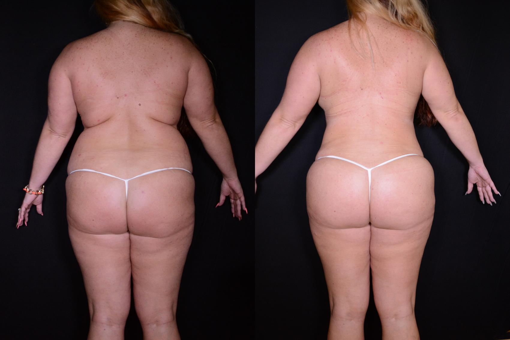 Before & After Brazilian Butt Lift Case 537 View #1 View in Panama City & Pensacola, Florida