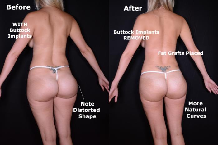 Before & After Brazilian Butt Lift Case 542 View #1 View in Panama City & Pensacola, Florida
