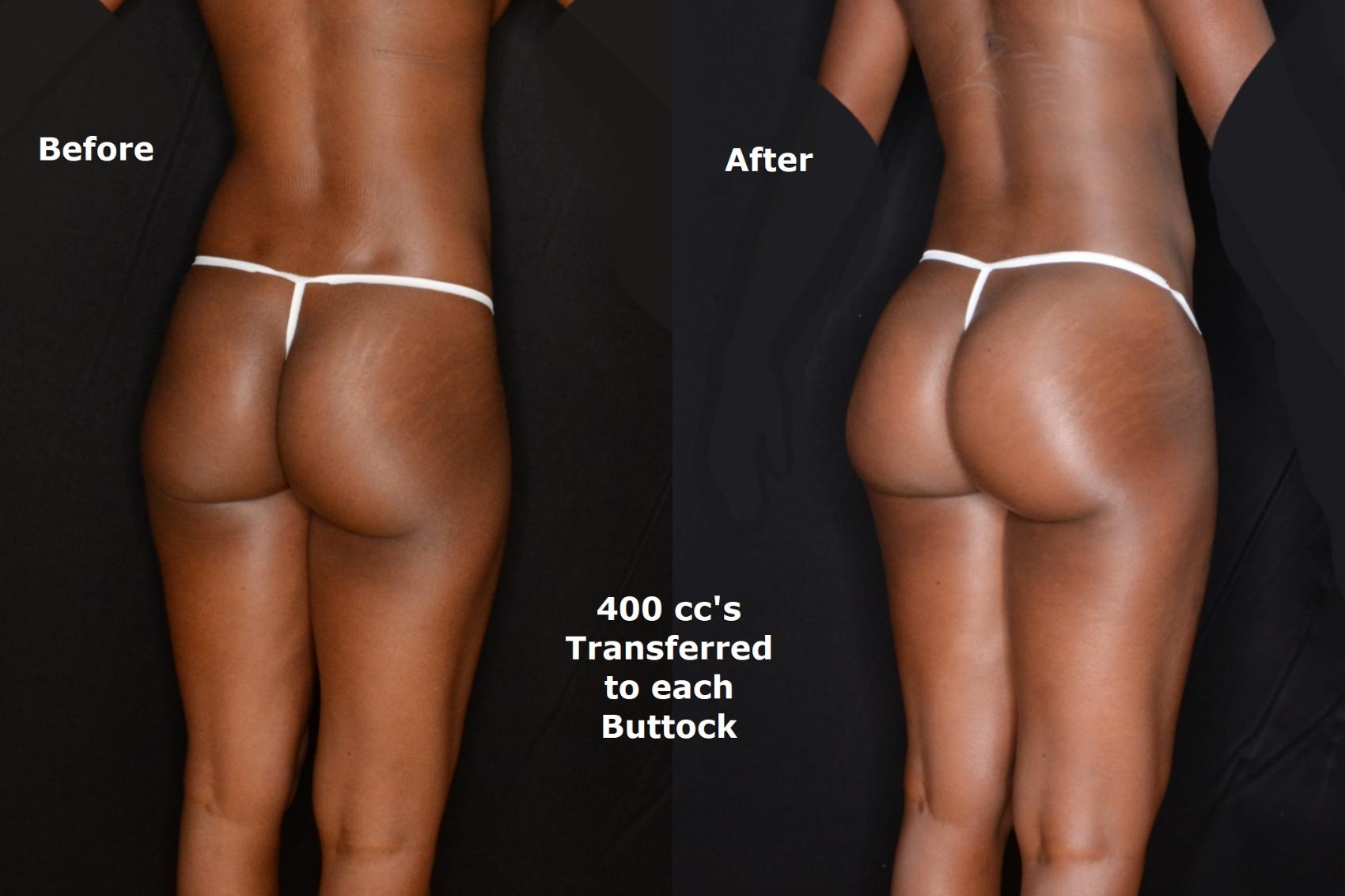 Before & After Brazilian Butt Lift Case 543 View #1 View in Panama City & Pensacola, Florida