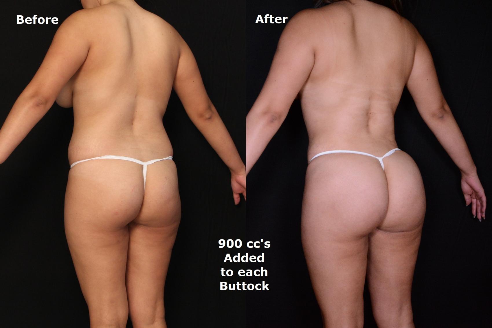 Before & After Brazilian Butt Lift Case 544 View #1 View in Panama City & Pensacola, Florida