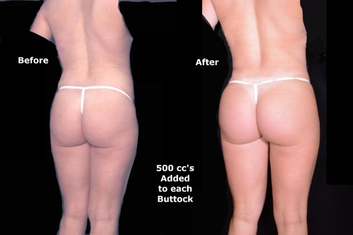 Before & After Brazilian Butt Lift Case 545 View #1 View in Panama City & Pensacola, Florida