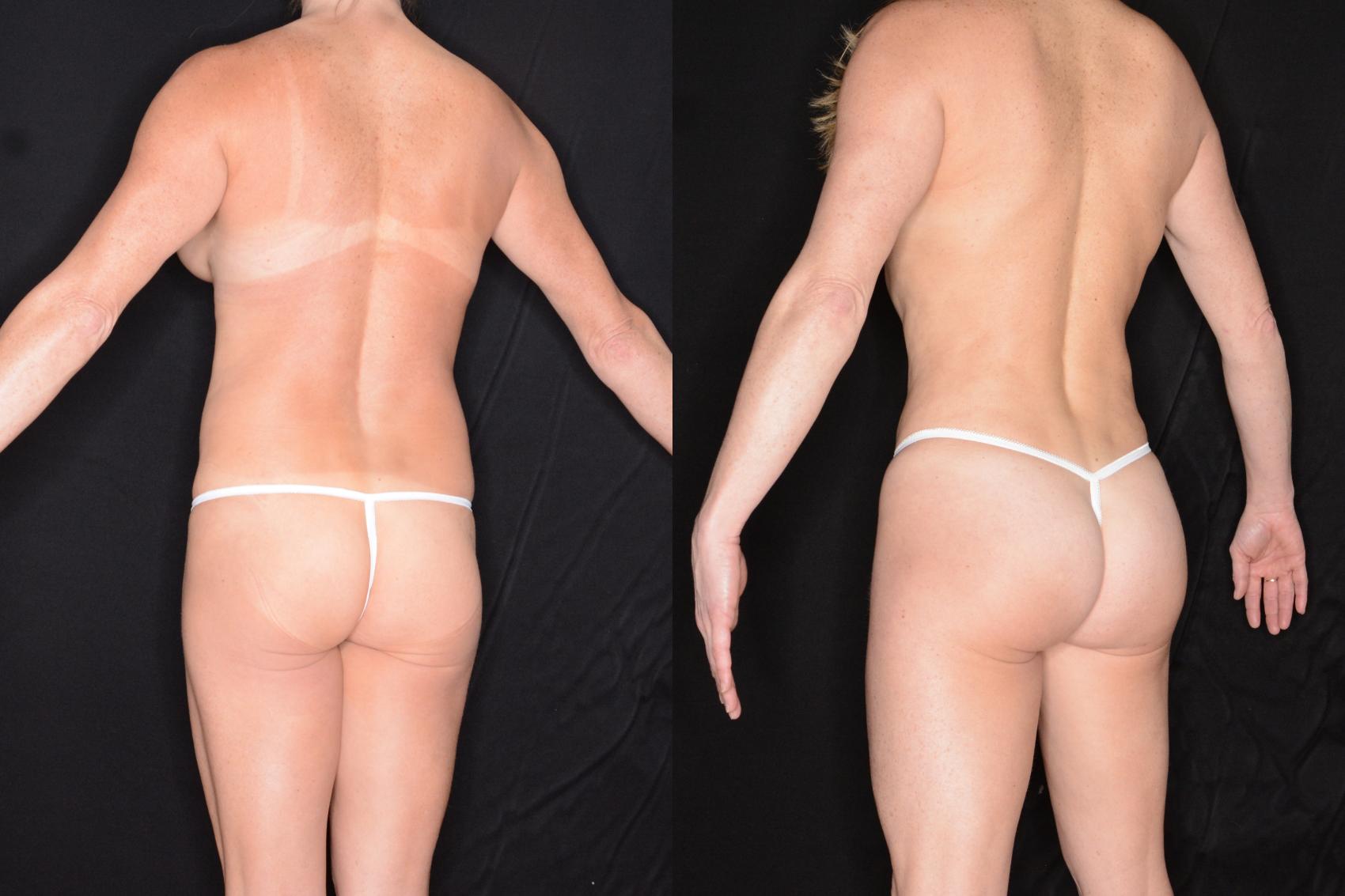Before & After Brazilian Butt Lift Case 601 View #1 View in Panama City & Pensacola, Florida