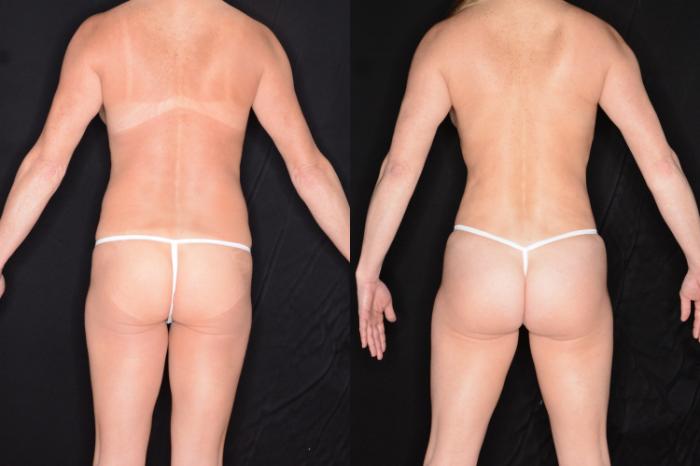 Before & After Brazilian Butt Lift Case 602 View #1 View in Panama City & Pensacola, Florida