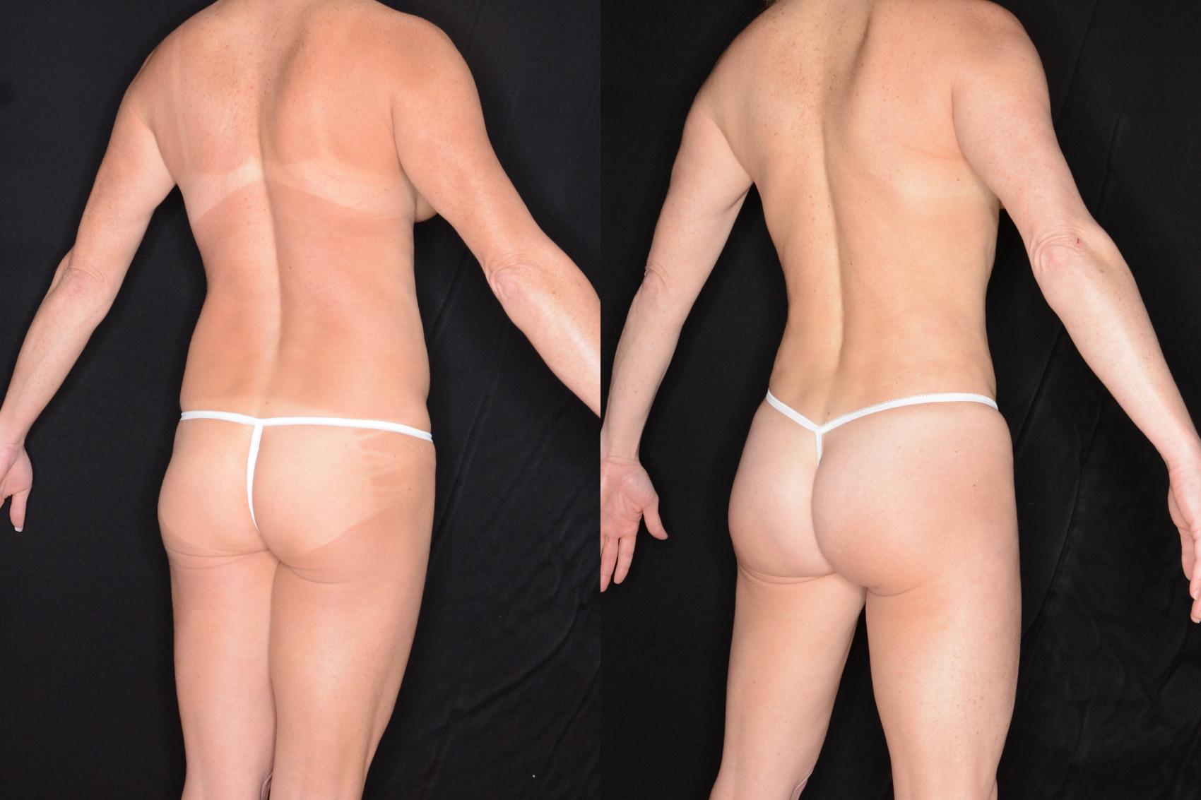 Before & After Brazilian Butt Lift Case 603 View #1 View in Panama City & Pensacola, Florida