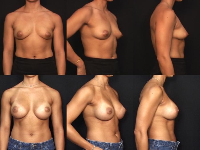 Before & After Breast Augmentation Case 1 View #1 View in Panama City & Pensacola, Florida