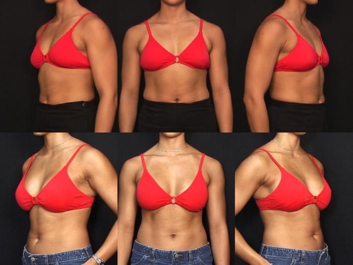 Before & After Breast Augmentation Case 1 View #2 View in Panama City & Pensacola, Florida