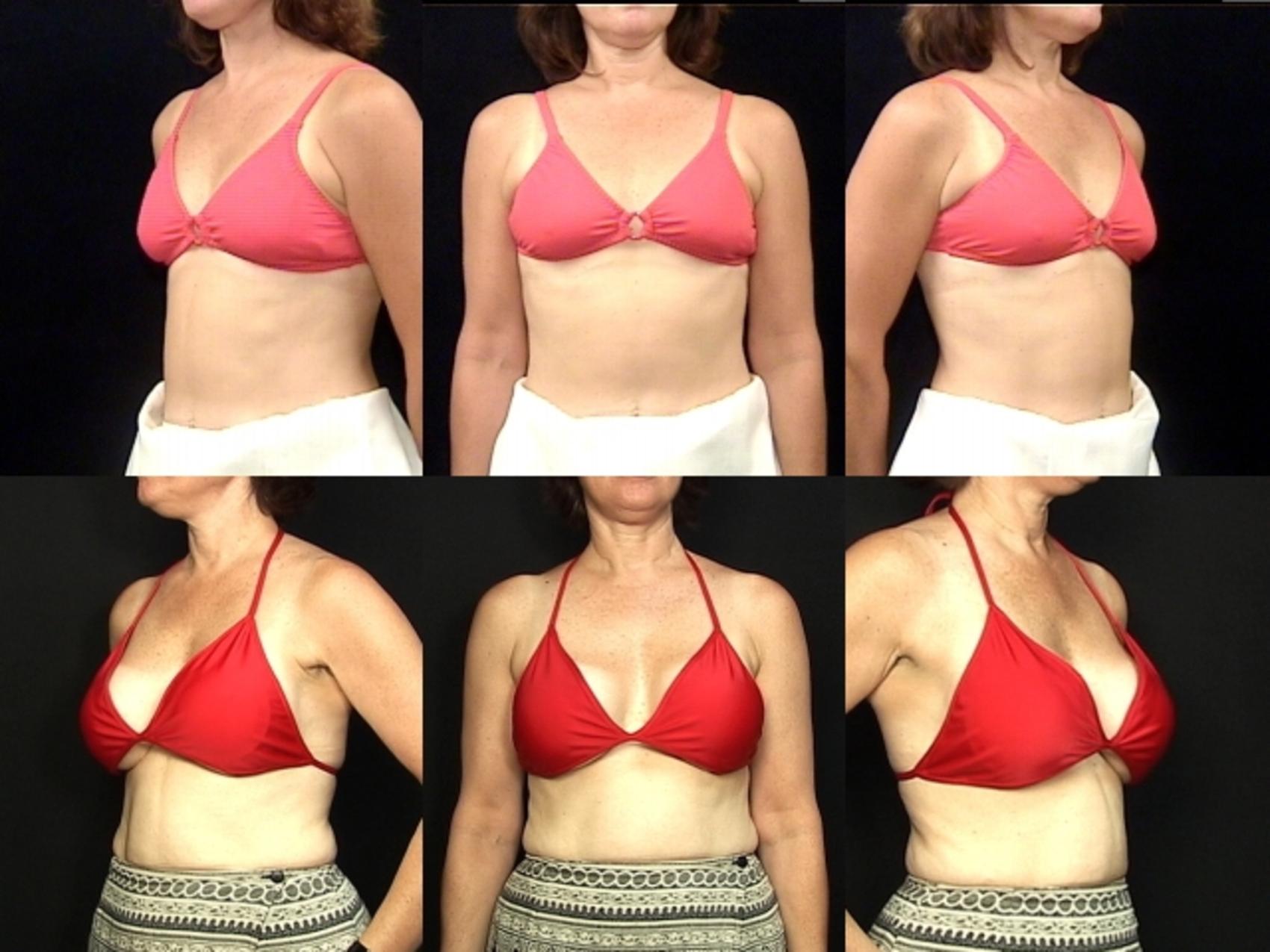 Before & After Breast Augmentation Case 112 View #2 View in Destin & Pensacola, Florida