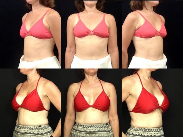 Before & After Breast Augmentation Case 112 View #2 View in Panama City & Pensacola, Florida