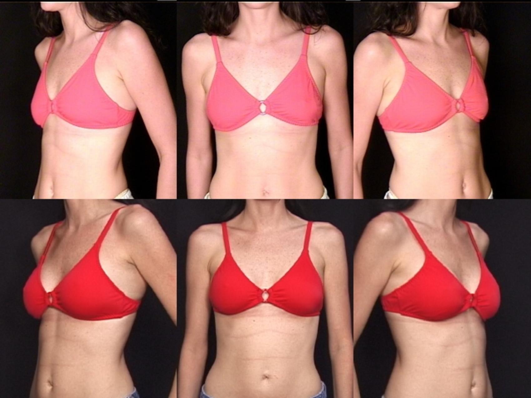 Before & After Breast Augmentation Case 114 View #2 View in Destin & Pensacola, Florida