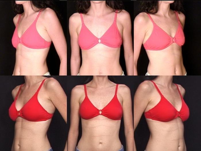 Before & After Breast Augmentation Case 114 View #2 View in Panama City & Pensacola, Florida