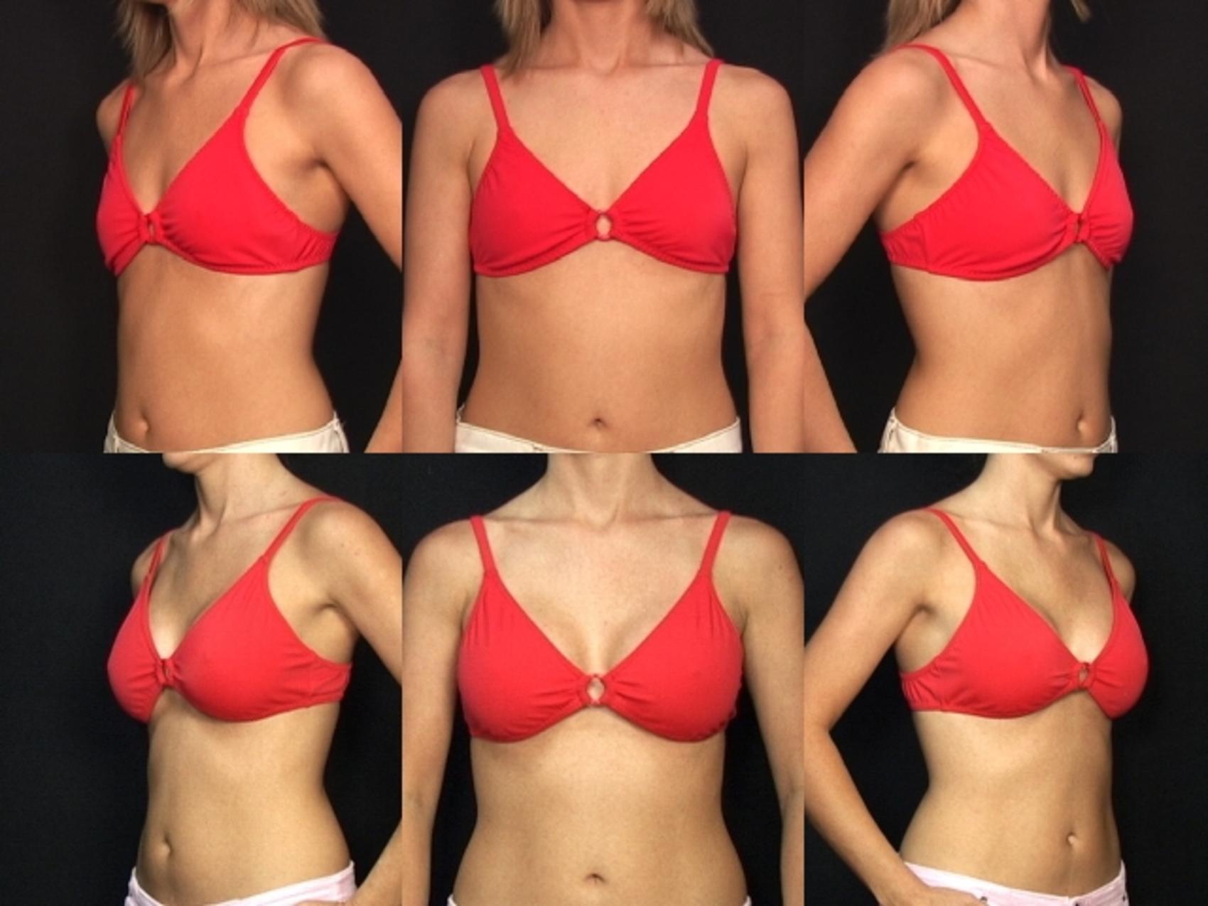 Before & After Breast Augmentation Case 117 View #2 View in Destin & Pensacola, Florida