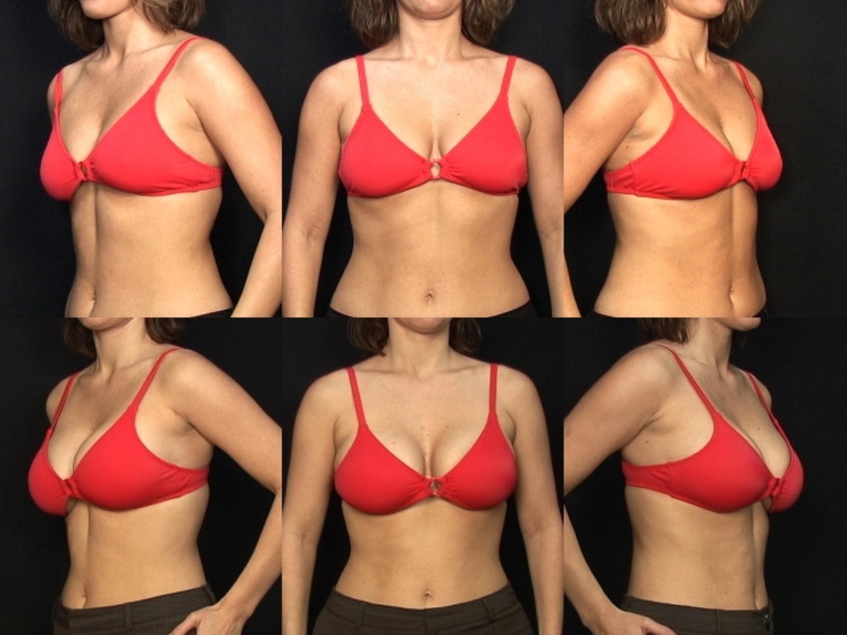 Before & After Breast Augmentation Case 118 View #2 View in Destin & Pensacola, Florida