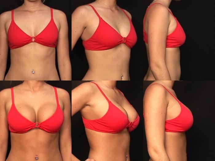 Before & After Breast Augmentation Case 121 View #2 View in Panama City & Pensacola, Florida